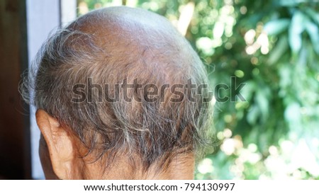 Close up Old man serious hair loss and gray hair problem with tree background