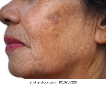 Close Up Old Woman Face, Melasma, Freckle, Aging, Skin Problem     