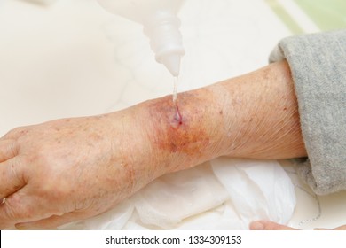 Close Up Old Woman Hand, Upper Limb Or Arm To The Wounded Waiting For Nurse Treatment On Wound Dressing A Bloody By Saline And Brine Of Patient.