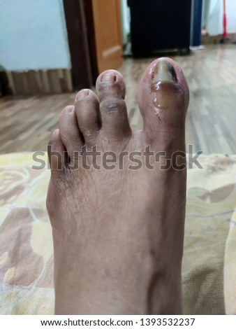 Close up of the old woman's toes nail which is infected by fungus, onychomycosis disease