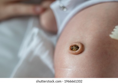 CLose Up On Belly Of Newborn Baby With Umbilical Cord Dried Stump Umbilical Granuloma Overgrowth Of Tissue During The Healing Process Of The Belly Button