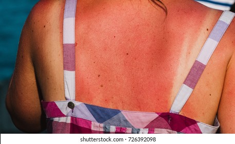 Close up on burnet skin by the sun on the woman