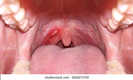 Close up on a canker sores. Inflammation of oral cavity. Very painful aphthae on uvula or soft palate. Really disturbing mouth ulcers. Anatomy of a inflamed buccal cavity. Reddened buccal mucosa. - Shutterstock ID 1832671759