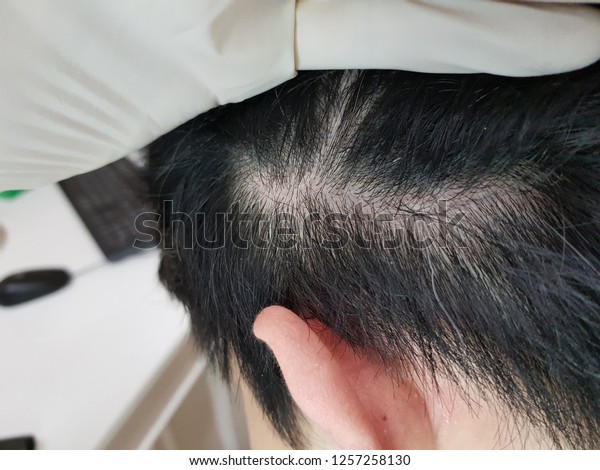 Close On Damaged Skin On Head Royalty Free Stock Image