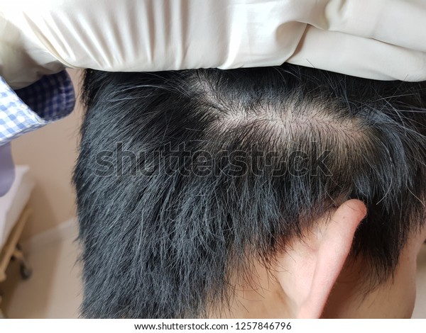 Close On Damaged Skin On Head Stock Image Download Now