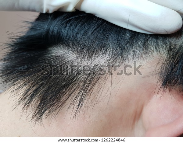 Close On Damaged Skin On Head Stock Image Download Now