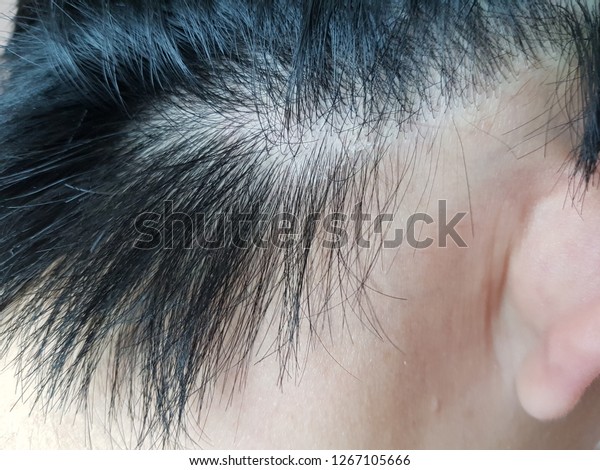 Close On Damaged Skin On Head Stock Photo Edit Now 1267105666