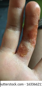 Close Up On Eczema, Impetigo, Atopic Dermatitis 