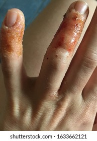 Close Up On Eczema, Impetigo, Atopic Dermatitis 