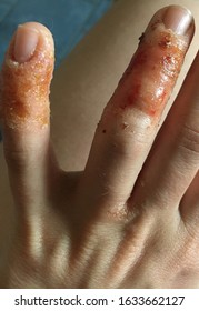 Close Up On Eczema, Impetigo, Atopic Dermatitis 