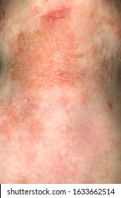 Close Up On Eczema, Impetigo, Atopic Dermatitis 