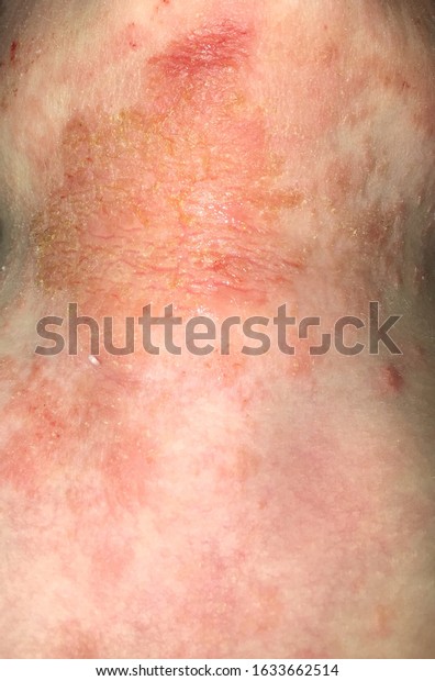 Close On Eczema Impetigo Atopic Dermatitis Foto Stok 1633662514 ...