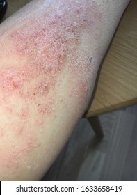 Close Up On Eczema, Impetigo, Rash 