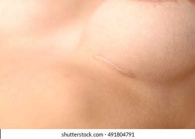 Close up on a female breast with insertion scar for a breast implant to enhance their beauty and size