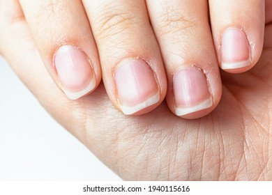 Close up on a female hands with dry skin and hangnails. Long fingernails and cuticles in bad condition. Chapped and neglected hands. Hands care concept. Lack of manicure in a lady fingers.