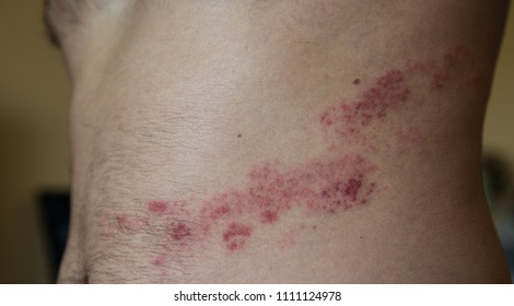 close up on herpes zoster on the stomach