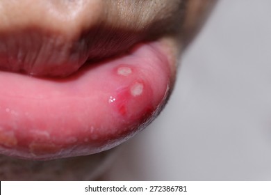 close up on the lip with aphthous stomatitis - Shutterstock ID 272386781