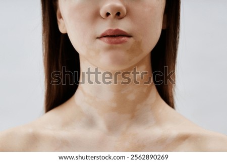 Close up on lips and bare collarbones of young woman with vitiligo patches confidently posing in studio embracing beauty of unique pattern on neck and face, copy space