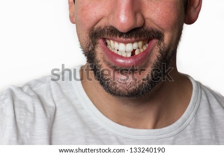 Close up on a man smiling while he is missing a tooth.