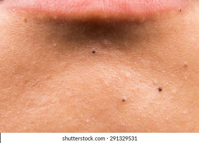 Close Up On Ugly Acne, Pimples, Zit, Blackheads On The Jaw Of A Teenager