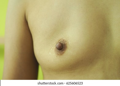 Close Up On Woman Breast, Show The Scar On Breast From Breast Operation Or Mastectomy (preserve Nipple)