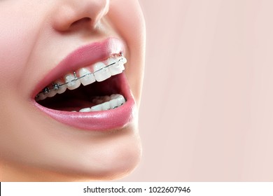 Close up open mouth with Ceramic and Metal Braces on beautiful Teeth. Broad Smile with Self-ligating Brackets. Orthodontic Treatment. Woman Smiling Showing Dental Braces.