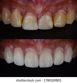 Close up in oral of front teeth before and after porcelain laminated dental ceramic veneers treatment for smile makeover.