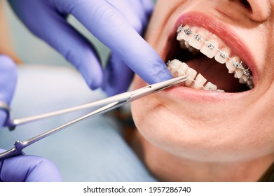 Close up of orthodontist hands in blue gloves using dental forceps while putting ligature wire on female patient teeth. Woman with metal braces on teeth receiving orthodontic treatment in clinic.