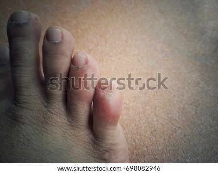 Close up Painful Swollen toes foot problem vintage tone color light effect with copy space for add text