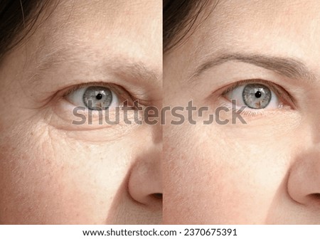 close up part face mature woman 55 years old, human eye, lower, upper eyelid, deep facial wrinkles around eyes before and after treatment, correction surgery, antiaging procedures