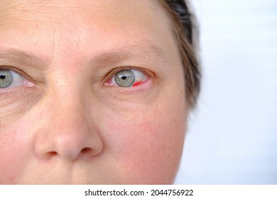 Close Up Part Of Middle-aged Woman's Face 50-55 Years Old, Human Bruised Eye, Burst Blood Vessel, Concept Of Surveillance, Peeping, Tracking, Vision Examination, Medical Procedures