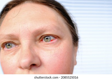 Close Up Part Of Middle-aged Woman's Face 50-55 Years Old, Human Bruised Eye, Burst Blood Vessel, Concept Of Surveillance, Peeping, Tracking, Vision Examination, Medical Procedures