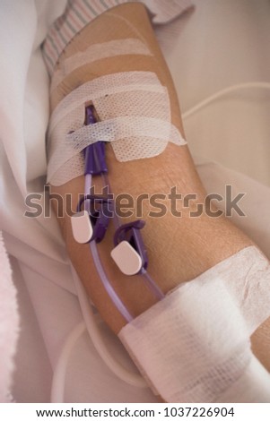 Close up of a patient's hand with Total Parenteral Nutrition (TPN) being administered into vein