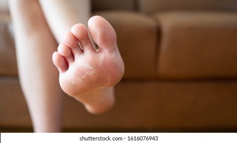 Close up of peeling and cracked foot. Causes of peeling foot included fungal infection (athlete's foot), dermatitis (eczema), sunburn, dry skin, dehydration or sweaty feet. Health care concept.