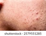 close up of a person with acne prone skin