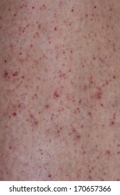 Close up of petechiae skin rash