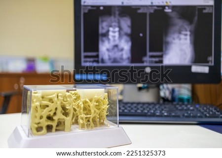Close up photo of bone model inside examination room in hospital.Model shown osteoporosis in elderly with monitor on background. Osteoporosis prone to fracture and spine collapse. Medical concept.