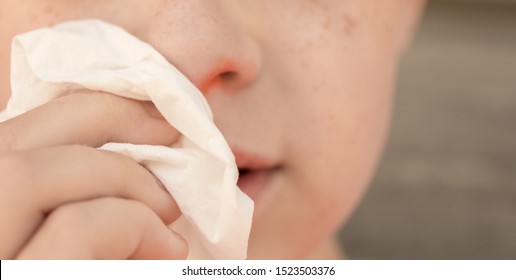 A Close Up Photo Of A Child's Red Stuffy Nose With A Kleenex.