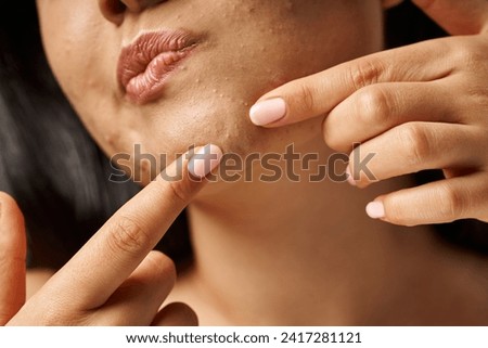 close up photo of cropped young woman with acne prone skin popping pimple on face, skin issues