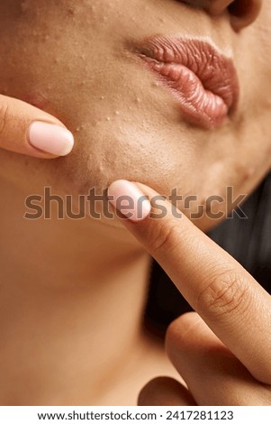 close up photo of cropped young woman with acne prone skin popping pimple on face, vertical shot