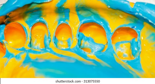 Close Up Photo Of Dental Impression Taken With Silicone Material