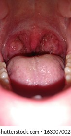 close up photo of a males pharynx while tonsillitis 