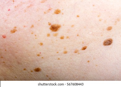 Close Up Photo Of Many Nevus On Human Skin