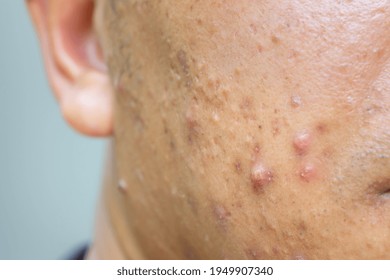 Close Up Photo Of Nodular Cystic Acne Blemish Spots Skin On Man Face