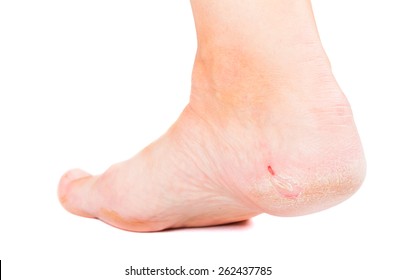 Hard skin on feet Images, Stock Photos & Vectors  Shutterstock