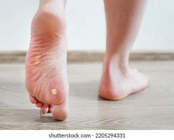 Close up photo of plantar wart on man's foot. Verruca plantaris on the heel. - Shutterstock ID 2205294331