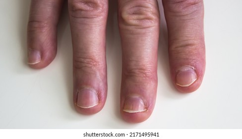 1,926 Unhealthy fingernails Images, Stock Photos & Vectors | Shutterstock