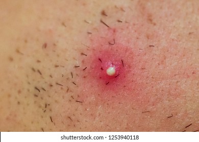 Close Up Photo Of Pustulous Cystic Acne.  Pimple Macro. Men's Face Acne Macro