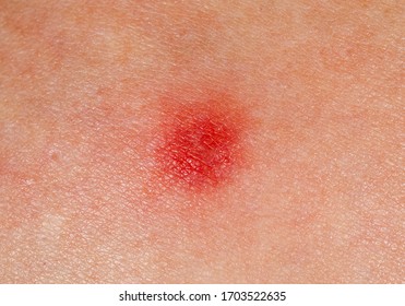 Red Patches On Skin Images, Stock Photos & Vectors | Shutterstock