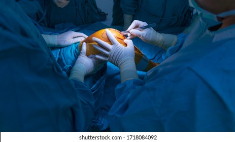 Close up photo of surgeon inside the operating room selective focus at surgeon 's hand with surgical blade. Doctor making incision on patient 's knee while doing total knee replacement surgery.